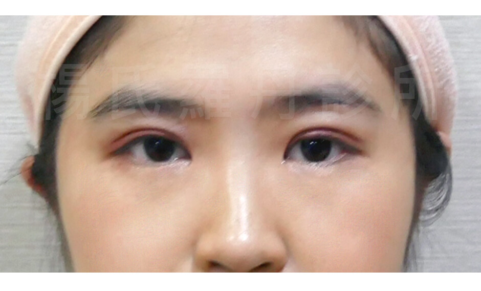 雙眼皮,醫學美容 楊氏羅丹 單眼皮